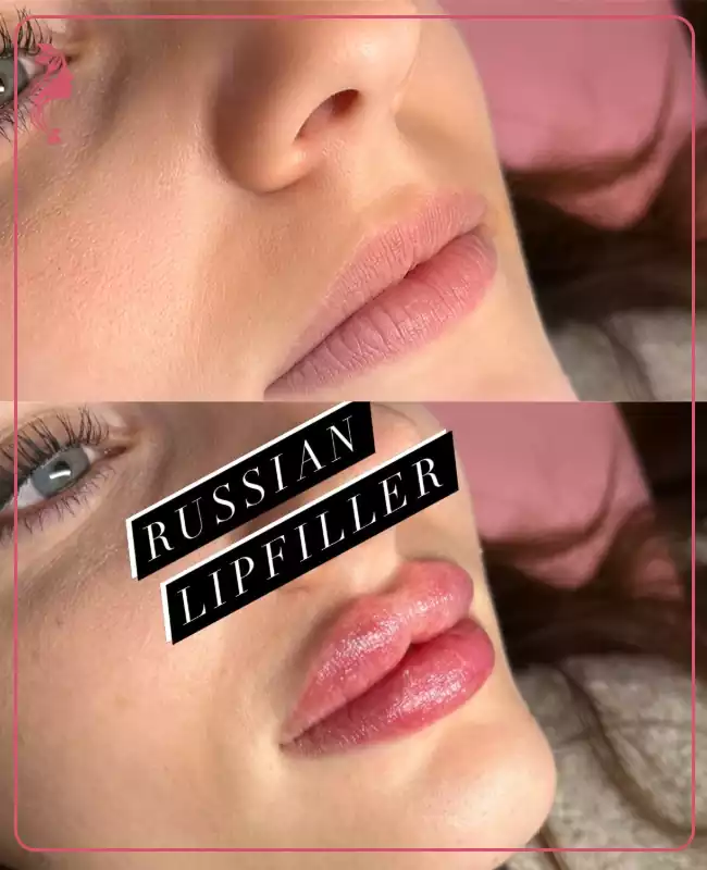 عکس قبل و بعد تزریق ژل لب روسی