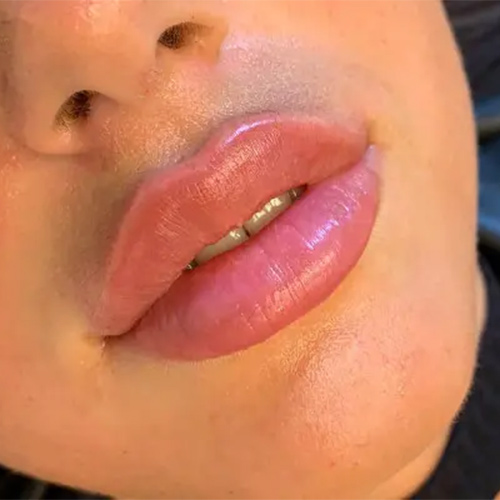 نمونه تزریق ژل لب روسی
