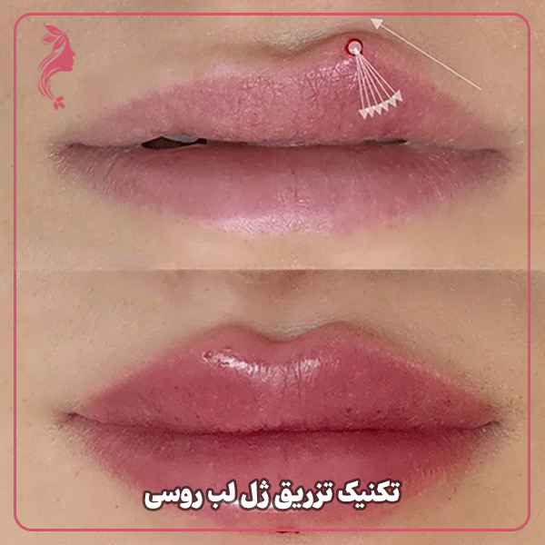 تکنیک تزریق ژل لب روسی