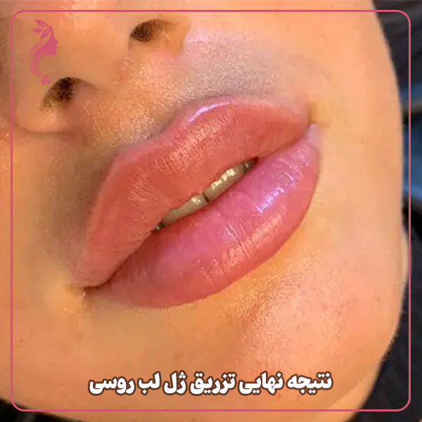 نتیجه نهایی تزریق ژل لب روسی