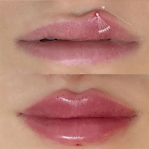نحوه تزریق ژل لب مدل روسی