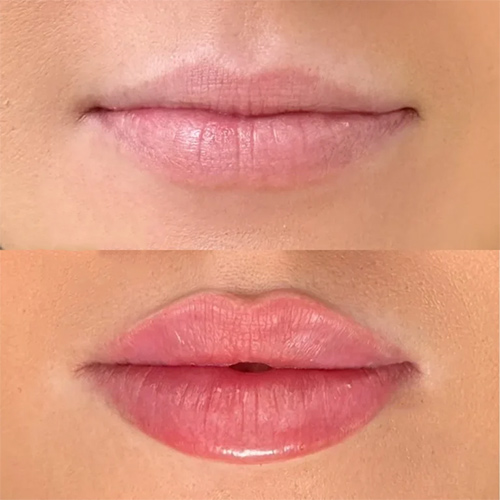نمونه تزریق زل لب مدل روسی در کلینیک دکتر سارا محمدی