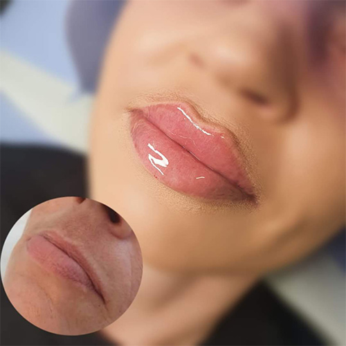 نمونه کار تزریق ژل لب روسی در فردیس