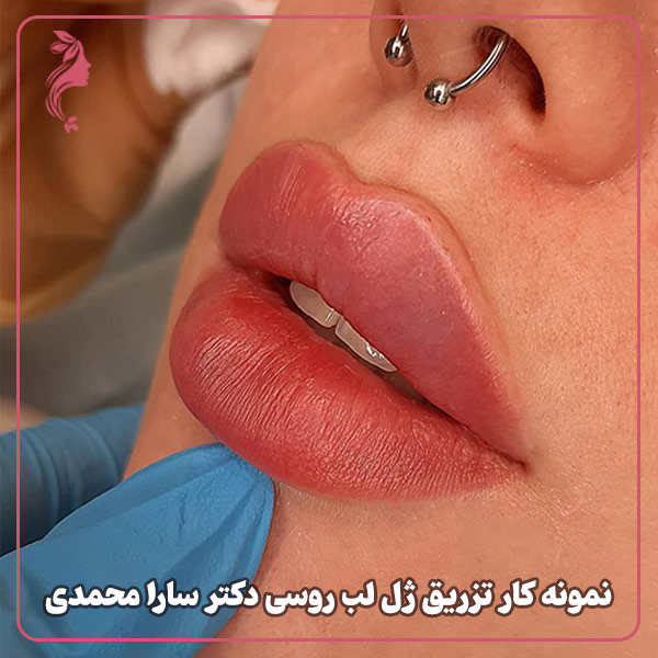 نمونه کار تزریق ژل لب روسی دکتر سارا محمدی