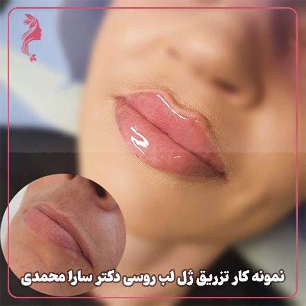 نمونه کار تزریق ژل لب روسی دکتر سارا محمدی