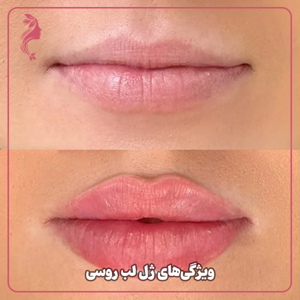 عکس قبل و بعد تزریق ژل لب مدل روسی