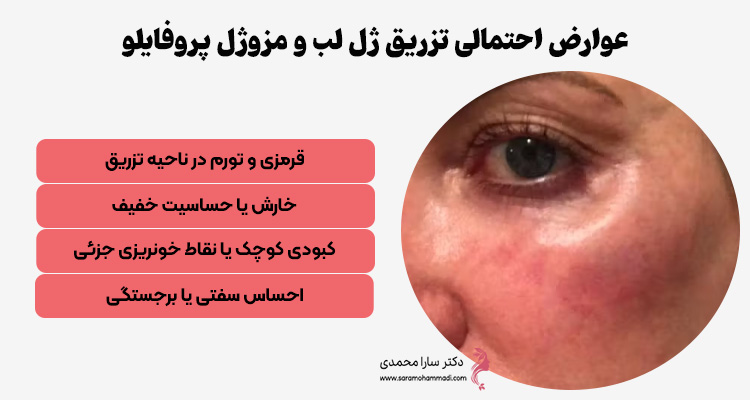 عوارض احتمالی تزریق ژل پروفایلو