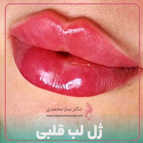 هزینه تزریق ژل لب قلبی در فردیس