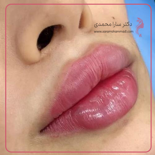 مراقبت های بعد از تزریق ژل لب مدل قلبی