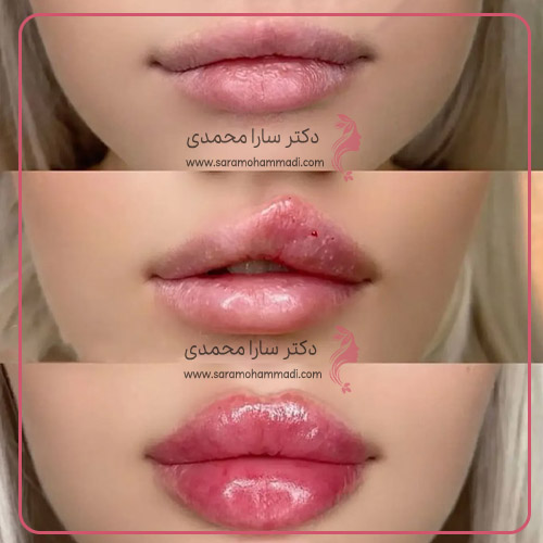 نکات پیش از تزریق ژل لب