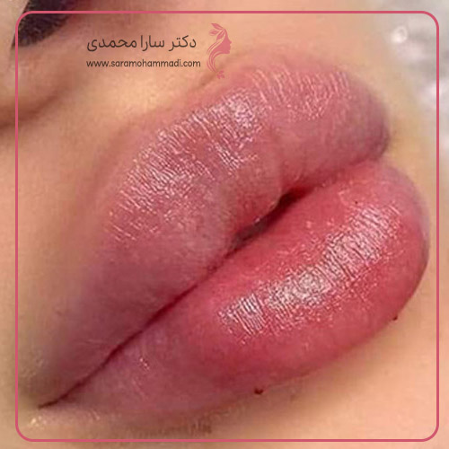 آیا امکان گلوله شدن ژل لب وجود دارد؟