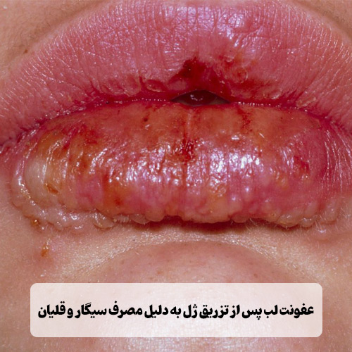 عفونت لب پس از تزریق ژل به دلیل مصرف سیگار و قلیان