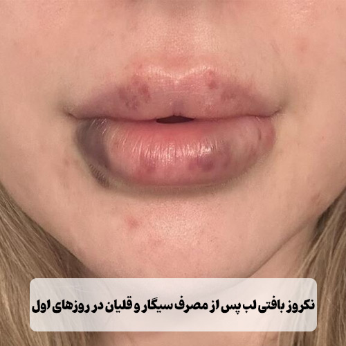 نکروز بافتی لب پس از مصرف سیگار و قلیان در روزهای اول