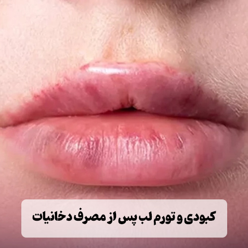 کبودی و تورم لب پس از مصرف دخانیات