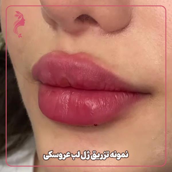 نمونه تزریق ژل لب مدل عروسکی دکتر سارا محمدی
