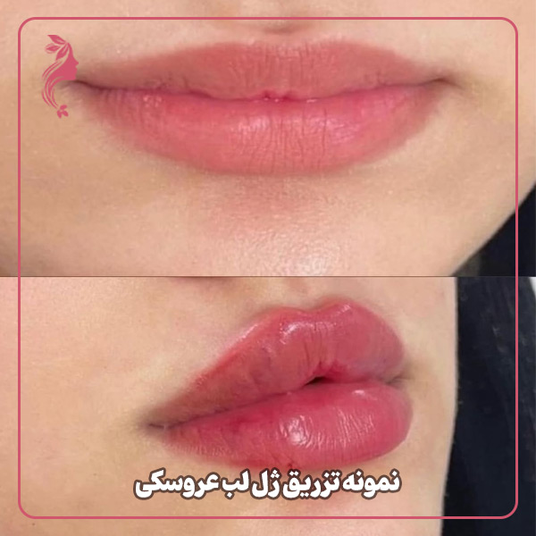 نمونه تزریق ژل لب مدل عروسکی دکتر سارا محمدی