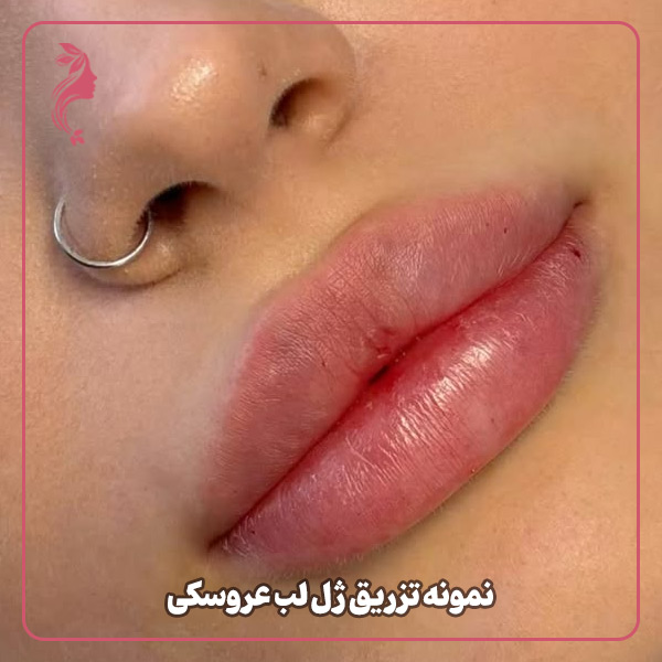 نمونه تزریق ژل لب مدل عروسکی دکتر سارا محمدی
