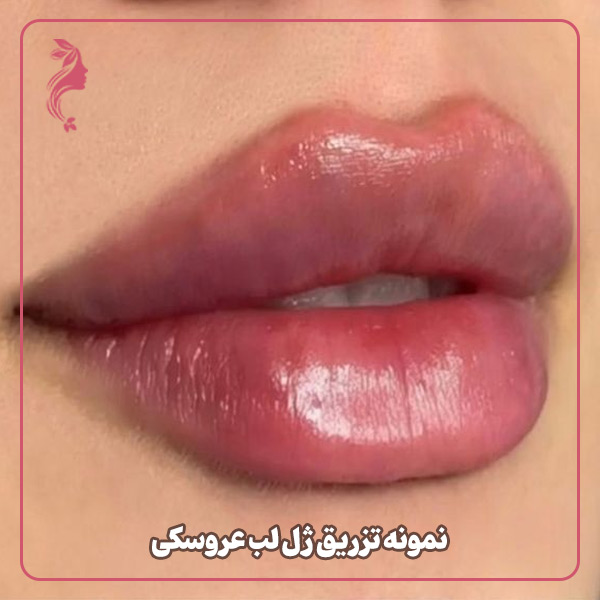 نمونه تزریق ژل لب مدل عروسکی دکتر سارا محمدی
