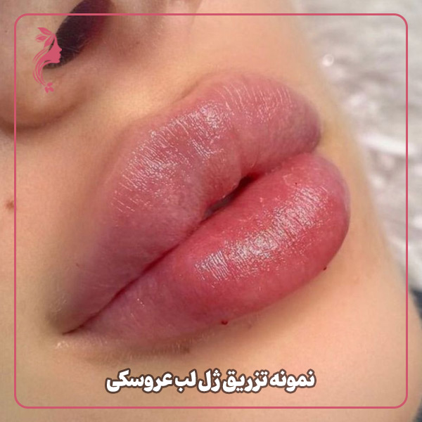 نمونه تزریق ژل لب مدل عروسکی دکتر سارا محمدی