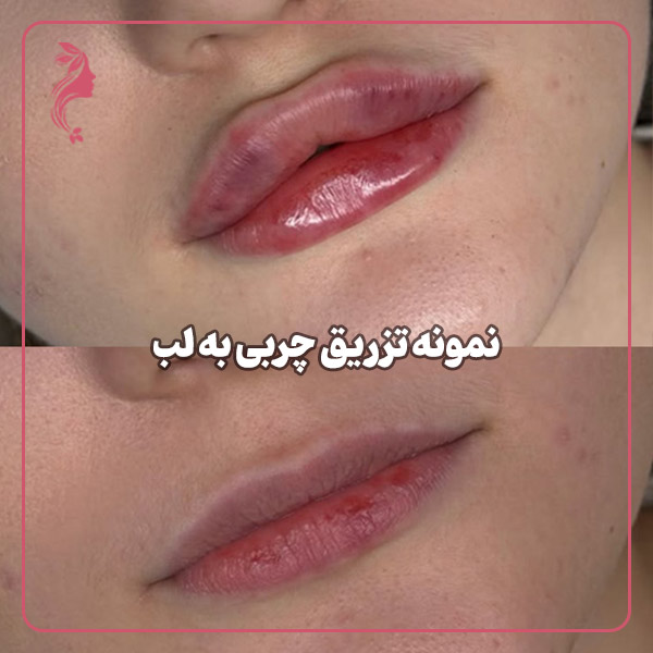 نمونه تزریق چربی به لب
