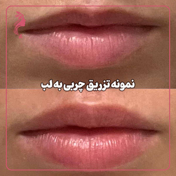 نمونه تزریق چربی به لب
