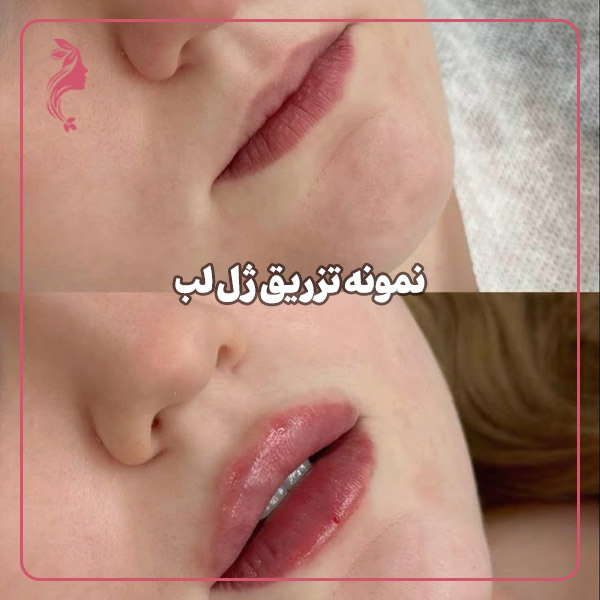 نمونه تزریق ژل لب