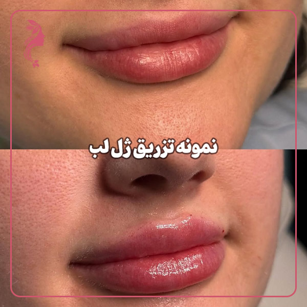 نمونه تزریق ژل لب