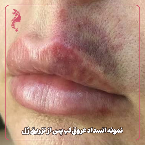نمونه انسداد عروق لب پس از تزریق ژل
