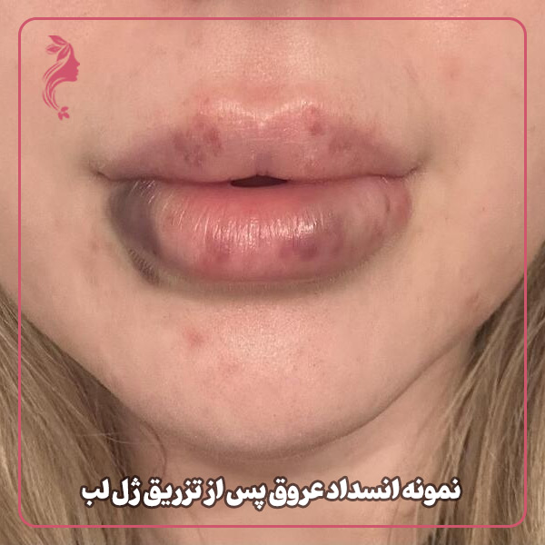 نمونه انسداد عروق پس از تزریق ژل لب