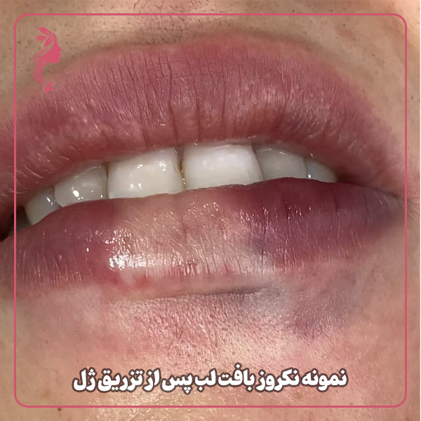 نمونه نکروز بافت لب پس از تزریق ژل