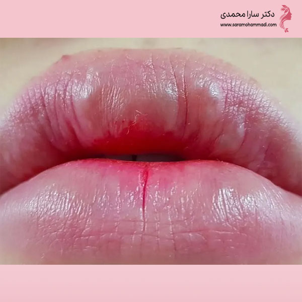 چگونه از گلوله شدن ژل لب پیشگیری کنیم؟