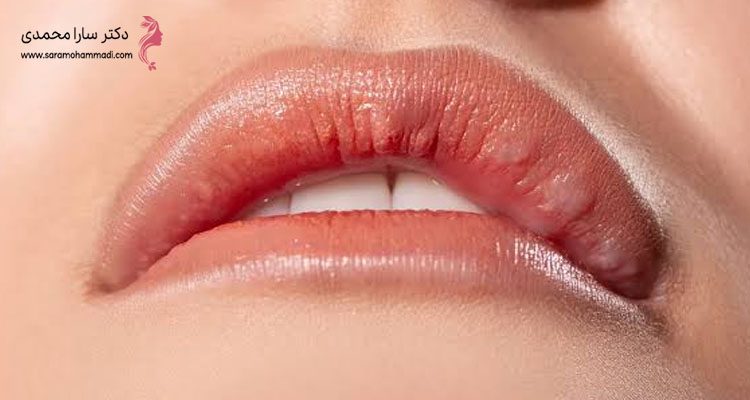 آیا گلوله شدن ژل لب طبیعی است؟