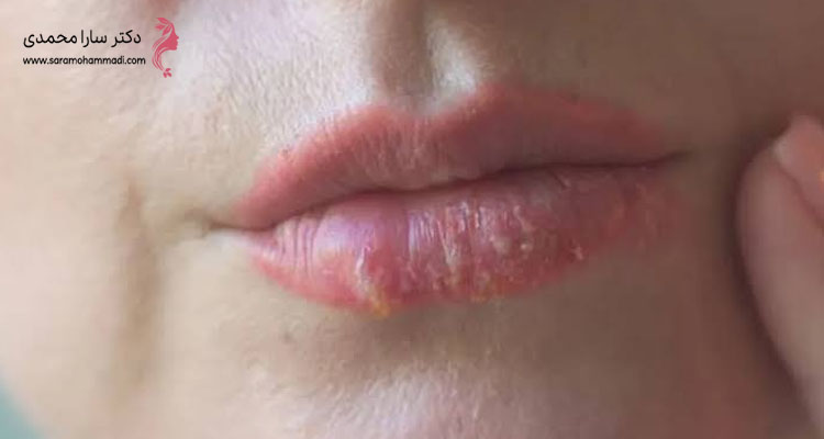 علل اصلی اصلی گلوله شدن ژل لب