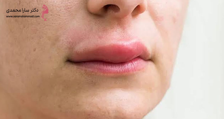 چگونه گلوله شدن ژل لب درمان می‌شود؟