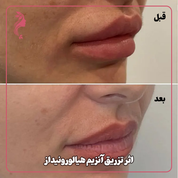 اثر تزریق آنزیم هیالورونیداز