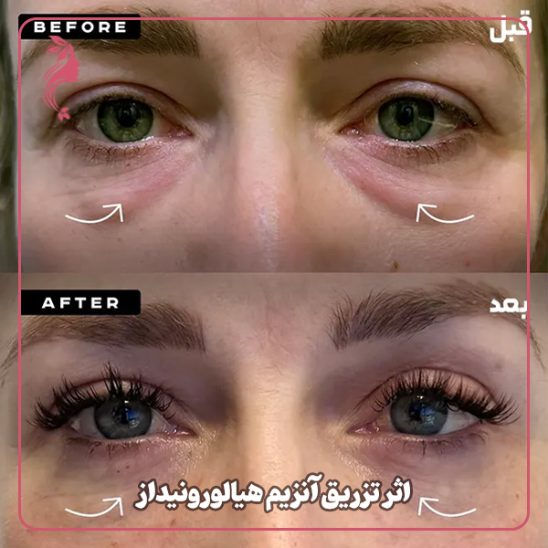 اثر تزریق آنزیم هیالورونیداز