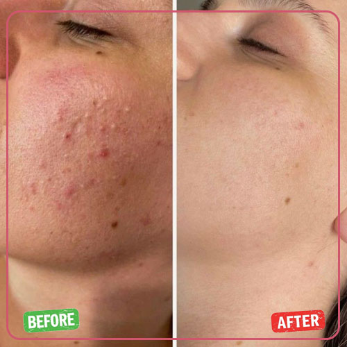 نمونه کار قبل و بعد پاکسازی پوست 5