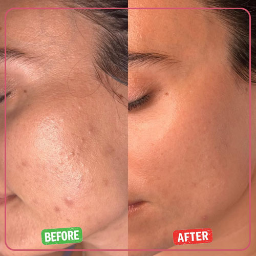 نمونه کار قبل و بعد پاکسازی پوست 1