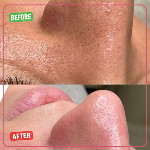 نمونه کار قبل و بعد پاکسازی پوست 2