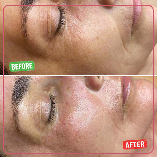 نمونه کار قبل و بعد پاکسازی پوست 3