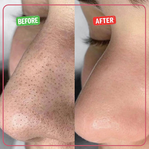 نمونه کار قبل و بعد پاکسازی پوست 4