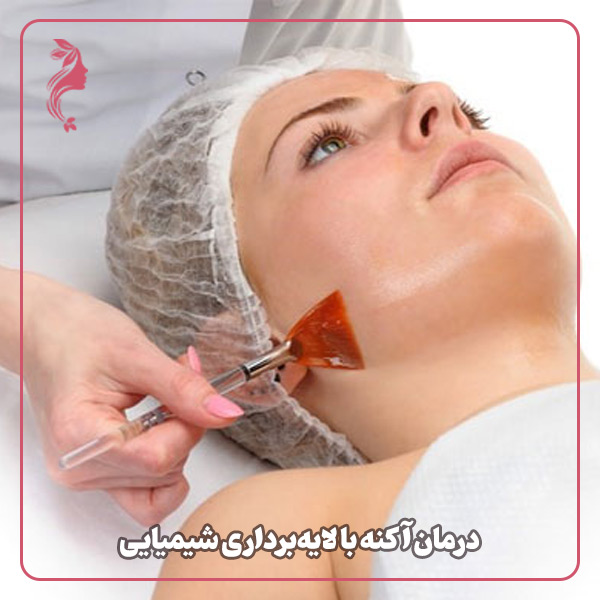 درمان آکنه با لایه‌برداری شیمیایی