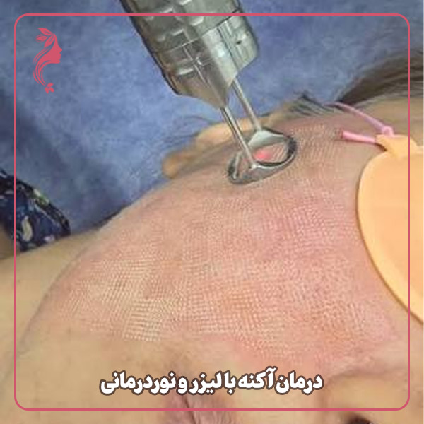 درمان آکنه با لیزر و نوردرمانی