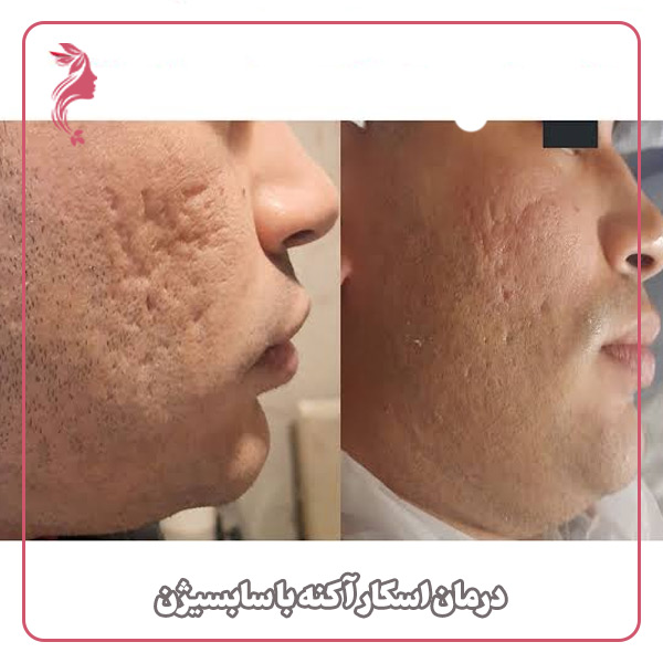 درمان اسکار آکنه با سابسیژن