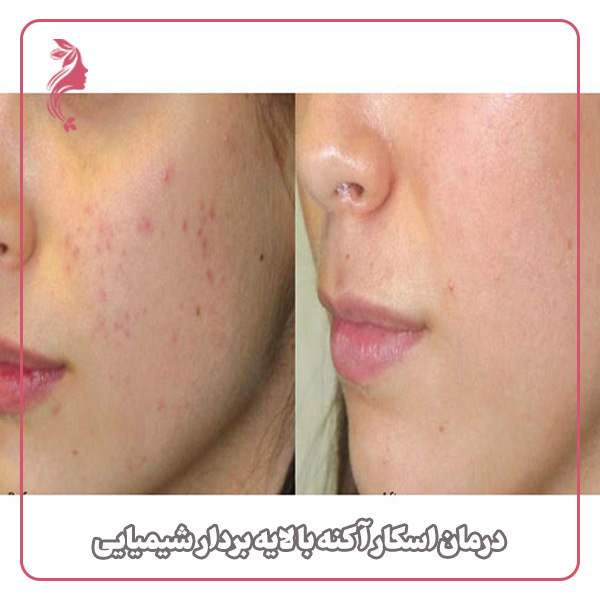 درمان اسکار آکنه با لایه بردار شیمیایی