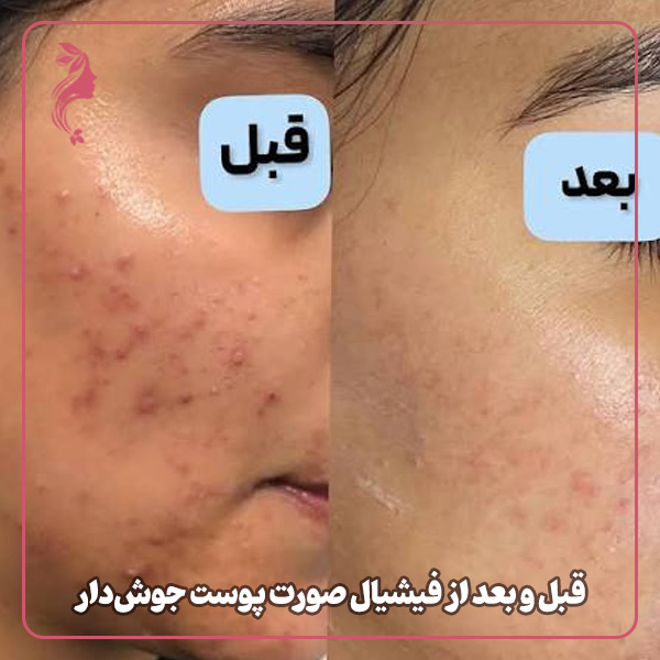 قبل و بعد از فیشیال صورت پوست جوش‌دار