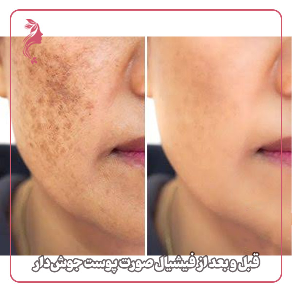 قبل و بعد از فیشیال صورت پوست جوش‌دار