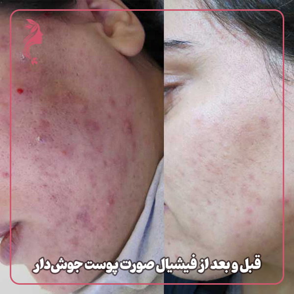 قبل و بعد از فیشیال صورت پوست جوش‌دار