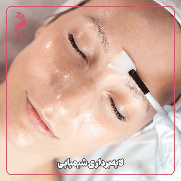 لایه‌برداری شیمیایی