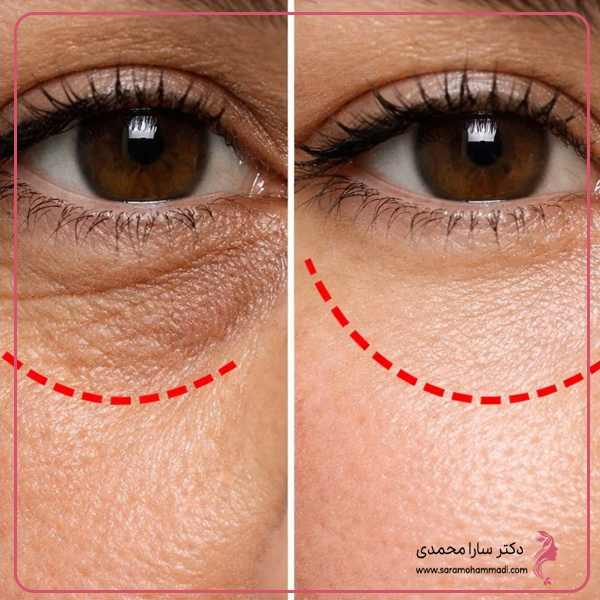 مزوژل زیر چشم چیست و چگونه عمل می‌کند؟ 